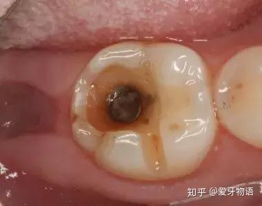 好多患者蛀牙疼到受不了,牙齿差不多烂了一半,直接上来就想让医生补