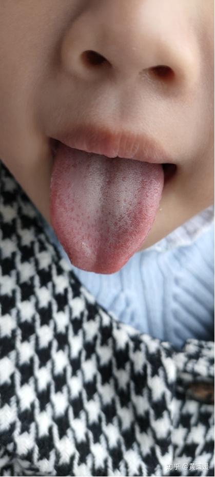 的孩子),前一张草莓舌比较明显,热比较重,舌头颜色深,第二张热轻一点