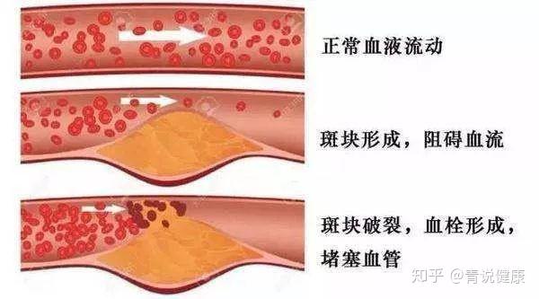 动脉硬化粥样硬化斑块有何不同应如何调理