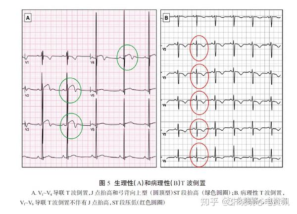 仅限于左室前壁导联的t 波倒置可被认为是一种正常的与年龄相关的心电