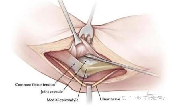 医生是怎样的给你做肘管综合症手术的?