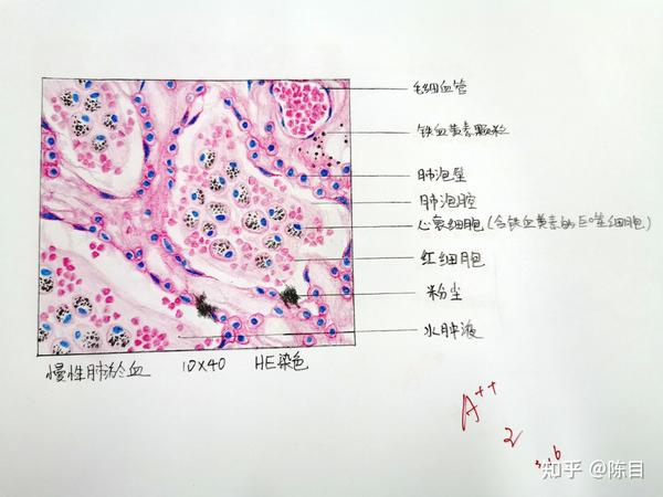 食管鳞状细胞癌 8.胃腺癌 9.脂肪肉瘤 10.动脉粥样硬化 11.