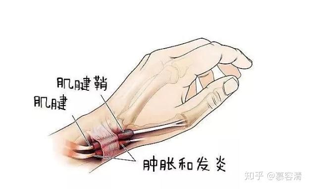 产后手腕疼也叫桡骨茎狭窄性腱鞘炎,发生疼痛的位置在大拇指近手腕的