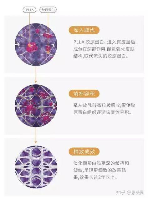 当我们在说聚左旋乳酸(plla)时,我们到底在说什么?