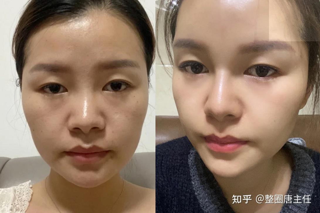 少女针填充效果好吗和玻尿酸有什么区别史上最全少女针科普帖避坑必看