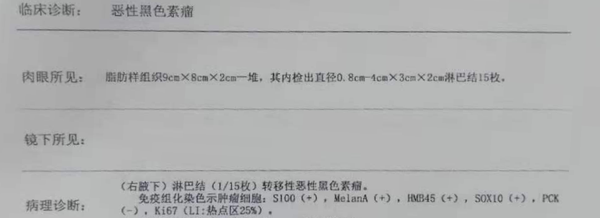 发现身上的一颗黑痣破溃到医院进行检查,不曾想被诊断出恶性黑色素瘤