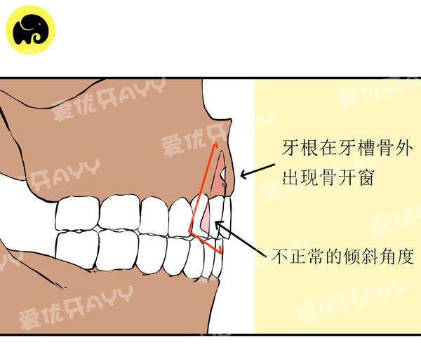 牙齿矫正导致骨开窗骨开裂,问题就出在这3点