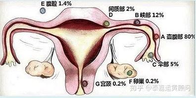 医学上吧输卵管分为4个部分,从外向里分别是伞端,壶腹部,峡部及间