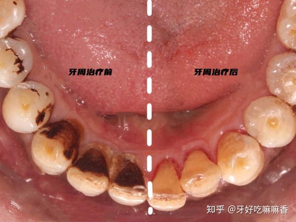 牙齿松动一定要拔掉吗有方法可以补救吗