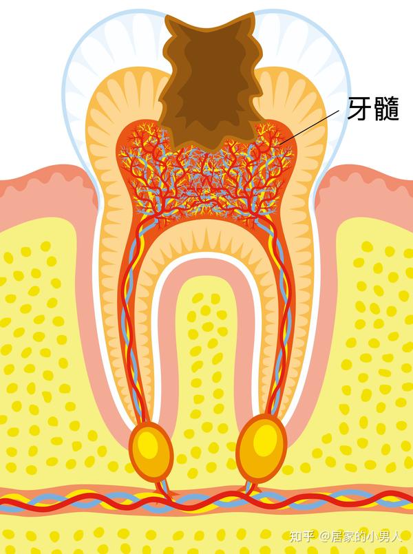 一颗蛀牙如果不及时补等待它的命运将是什么