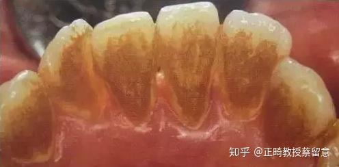 郑州牙齿矫正:牙周炎会偷偷吃掉你的骨头