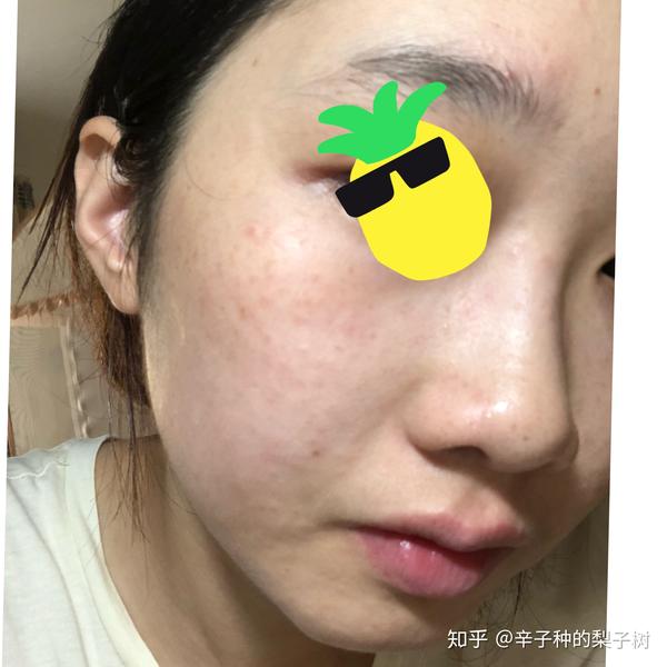 脸上长了很多又红又痒逆光疹子,有些透明的尖头看起来