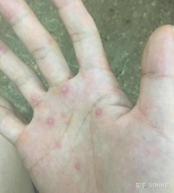 成年人的手足口病—伴随终身的疾病