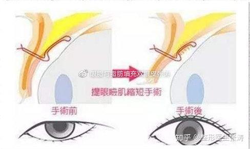 因此,提肌手术是需要切开上睑皮肤的,那么如果术后既没有
