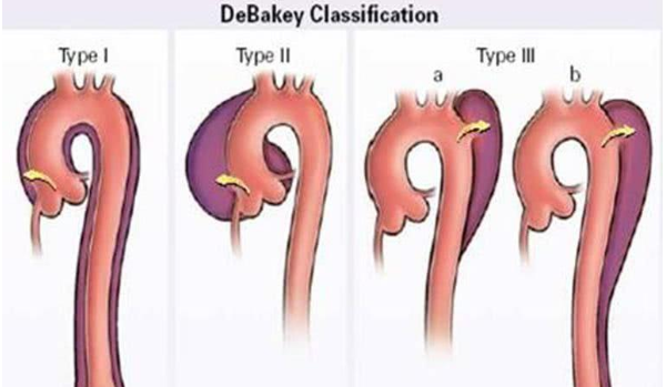 从胸痛到背主动脉夹层症状有哪些6招教你预防