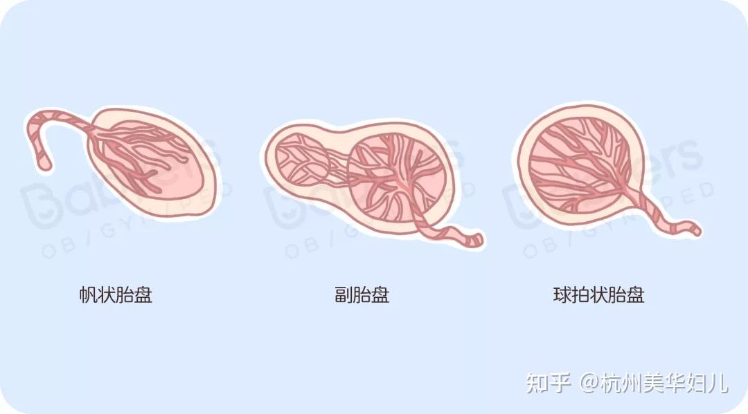 扎错根的粘连性胎盘/植入性胎盘正常情况下,我们胎盘是附着在子宫壁的