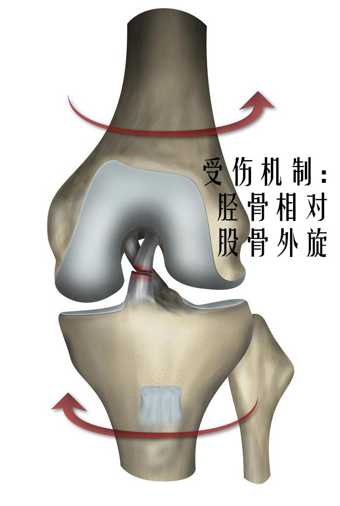 前交叉韧带撕裂了该怎么办?