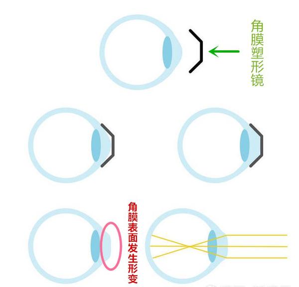 睡一觉就能控制近视的角膜塑形镜,你竟然还不知道?