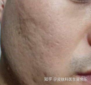 挤痘痘留下的痘坑怎么治疗?