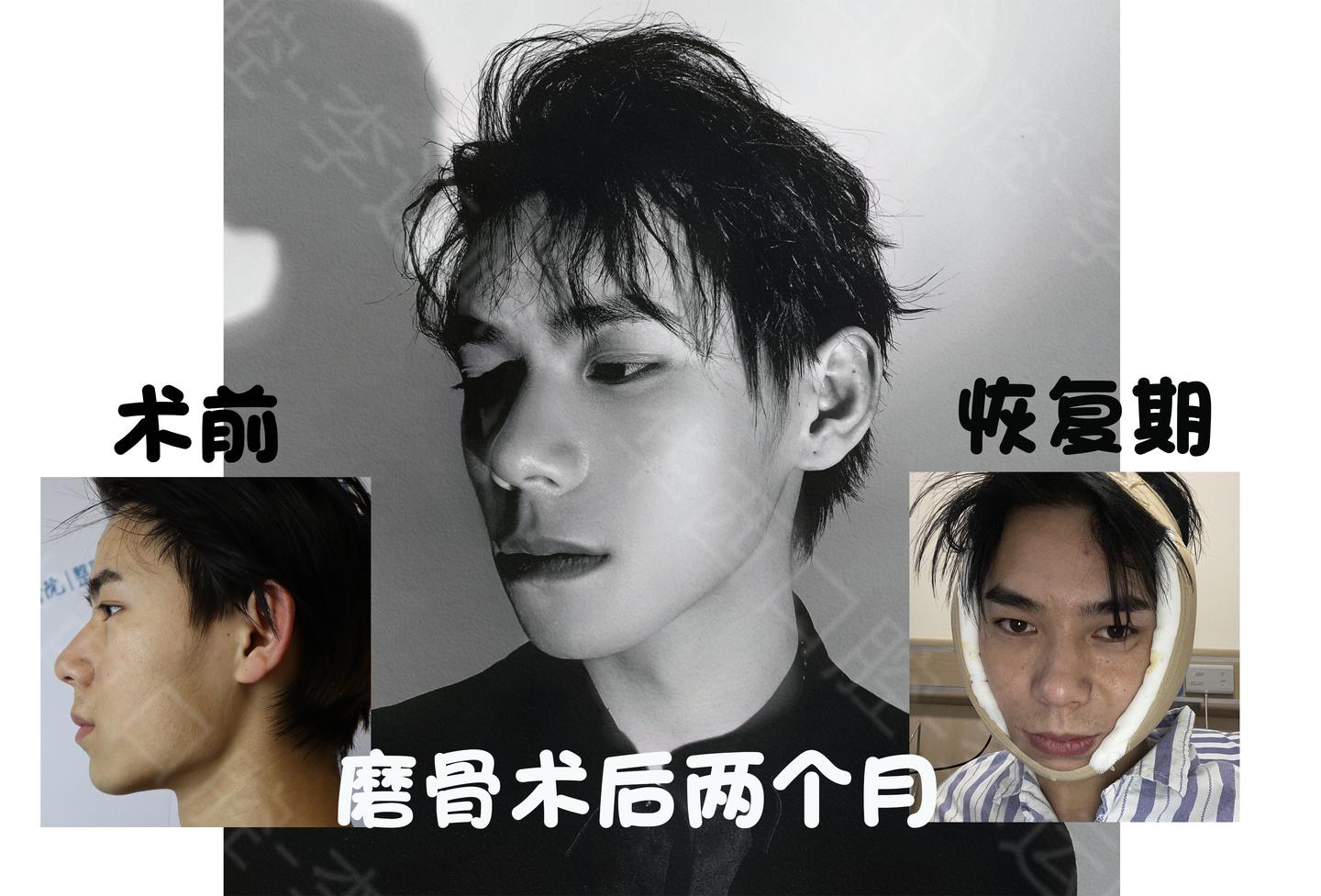 男士颌面术后反馈长曲线下颌角颧骨降低颧弓内推