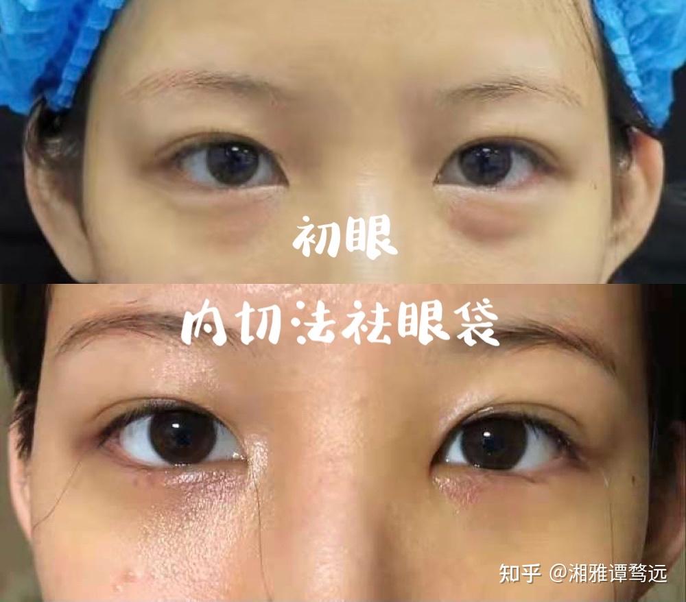 长沙谭医生眼部年轻化案例分享(双眼皮祛眼袋)