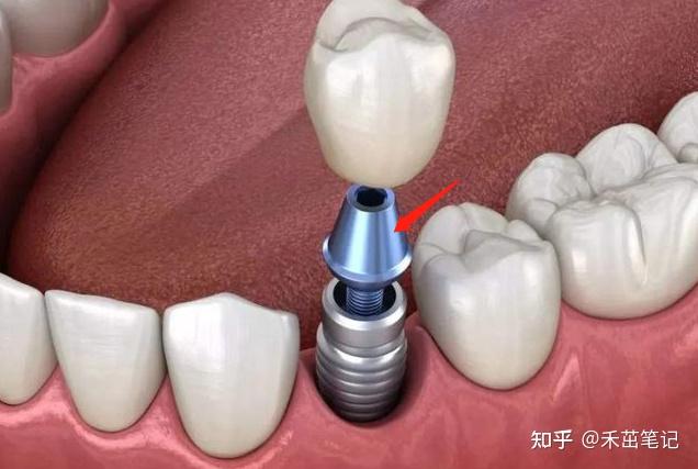 长沙牙齿种植2021全攻略种牙流程解读