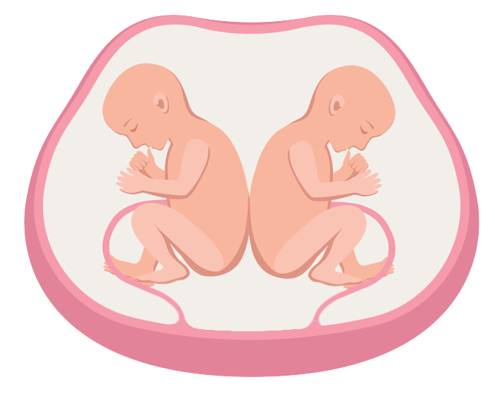 聊点不一样的孕妈知识 1 人 赞同了该文章 单卵双胎(monozygotic
