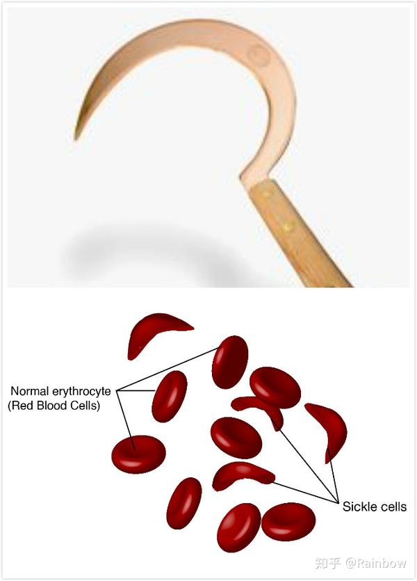 sickle的意思是镰刀,常见的词有sickle cell anemia 镰刀形红细胞贫血