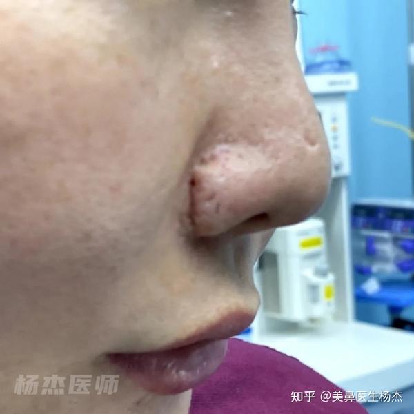 鼻翼疤痕修复|常见鼻翼疤痕类型及原因分析