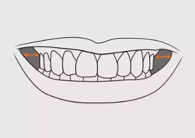 这是在嘴角处可见的小黑色空间,它与微笑的宽度,嘴唇的形状和牙弓的