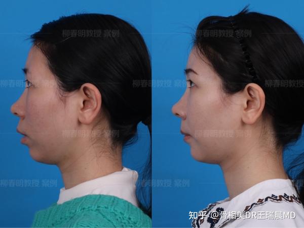 正颌手术案例分享双颌前突矫正术