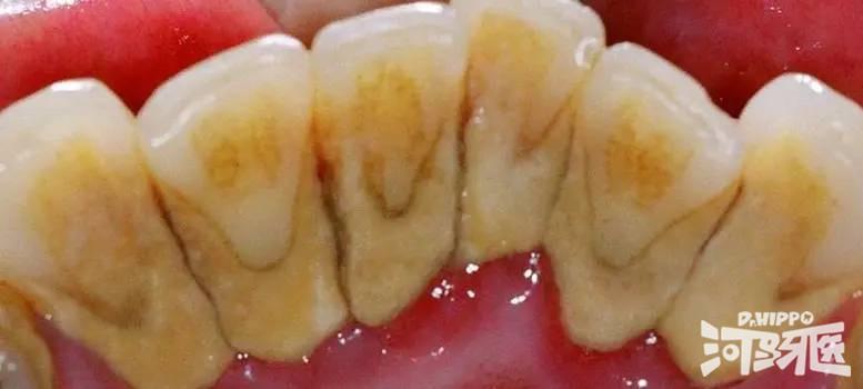 简单说,牙结石就是黄色,棕色甚至黑色的,存在于牙齿的颈部与表面(比如