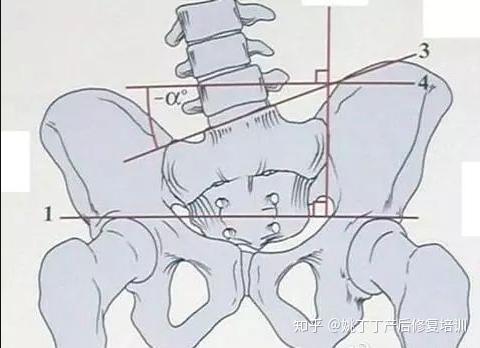 产后骨盆疼痛如何防止骨轮变形