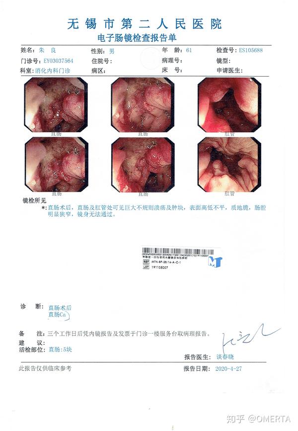 1个多月的联合治疗转移复发的直肠癌肿瘤淋巴结一扫而光