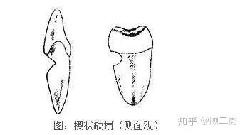 牙颈部楔状缺损 由于牙龈萎缩和牙刷毛太硬,在牙面接近牙龈部分,牙