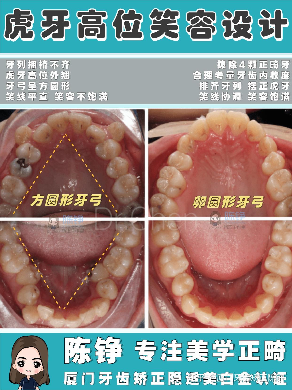 厦门牙齿矫正陈铮聊正畸美学虎牙高位牙列不齐的笑容设计