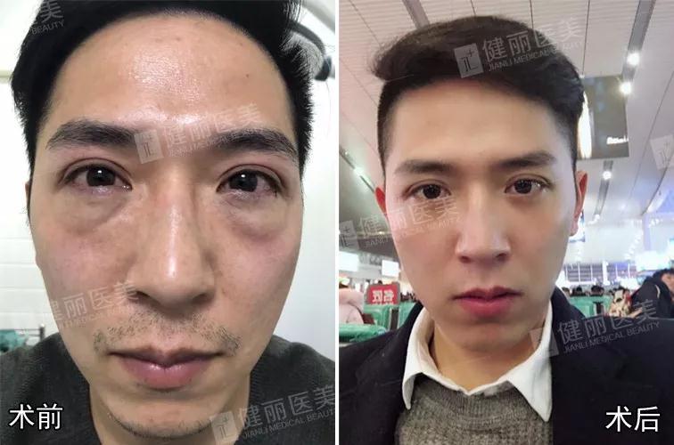35岁的去眼袋小哥为何火爆全网这10张图告诉你答案