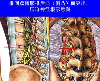 廖顺才上海十院骨科虹桥院区:腰椎间盘突出症危害