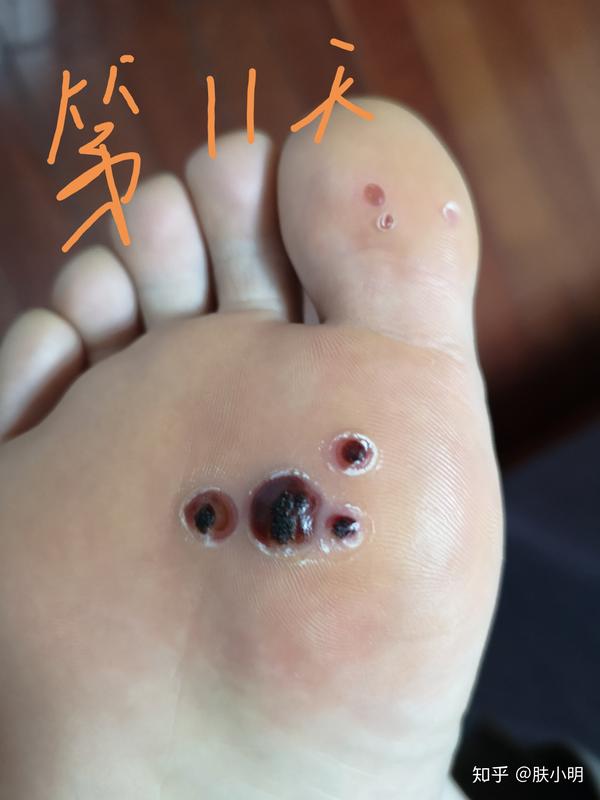 跖疣怎么样才算是去根