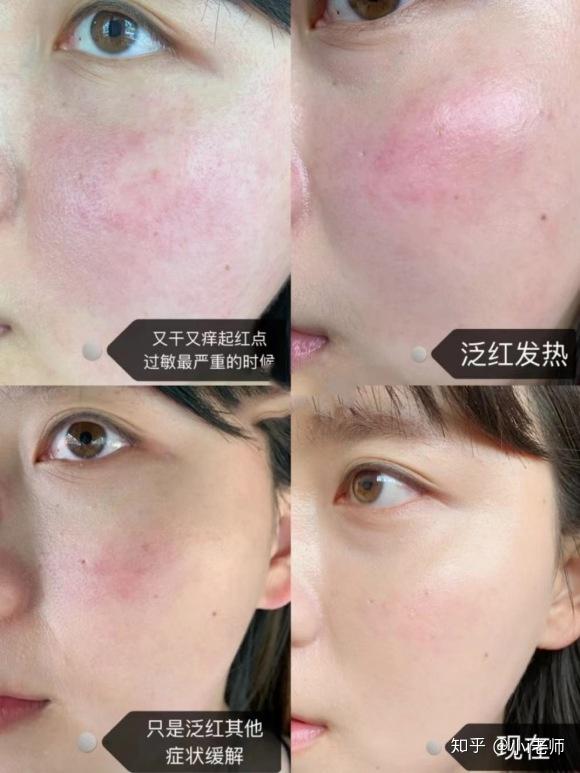 28天改善敏感肌红血丝,神仙闺蜜推荐(红血丝,激素脸看过来!