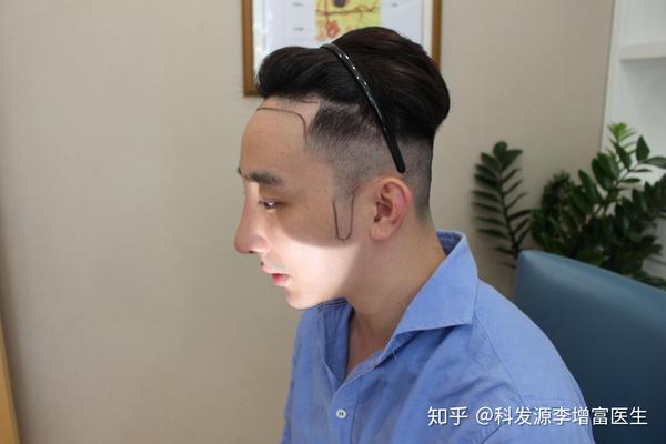 发际线高 发际线后移 鬓角种植,科发源植发恢复分享