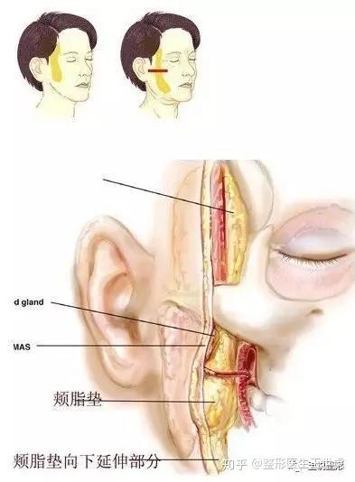 颊脂垫示意图(网络图片)