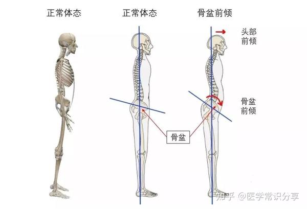 因侧面腹部(腹内,外斜肌)和腰方肌过度收缩,而使这一侧的骨盆抬高