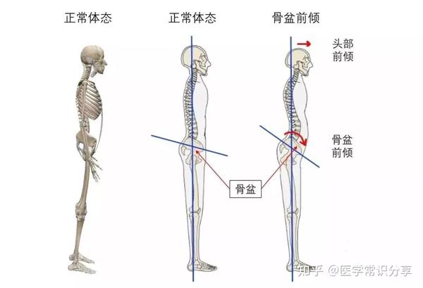 简单来说 骨盆是连接脊柱底端和腿部的骨性结构,具有旋转或倾斜