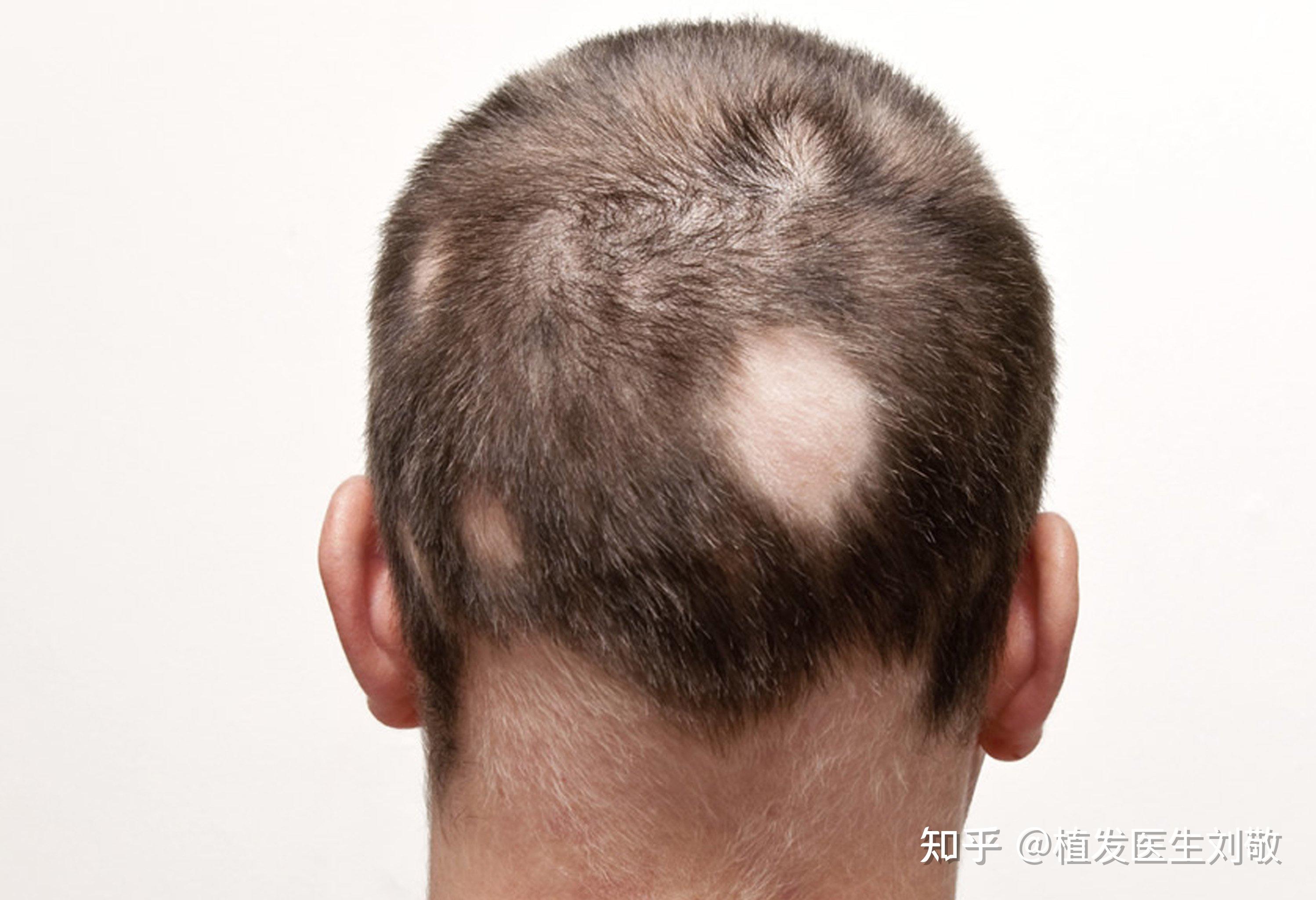什么是斑秃产生斑秃的原因有哪些如何治疗