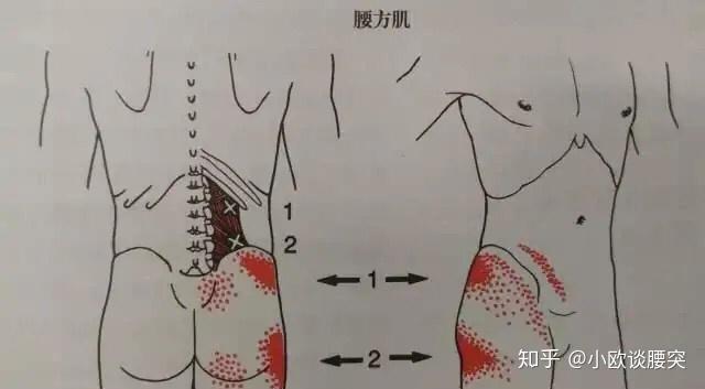 腰痛与腰方肌的关系,如何处理?方法很简单