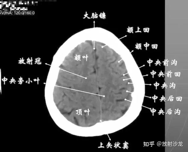 圆区上部层面) 已近颅顶,大脑镰清晰可见,其旁的脑灰质和脑沟十分清楚