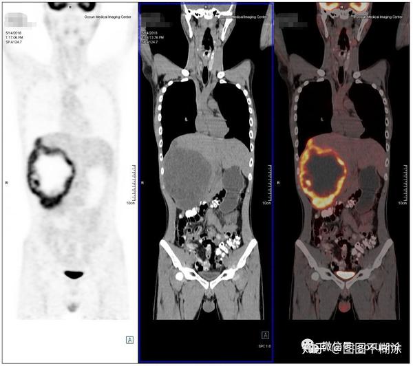 【pet/ct专辑】筛查肿瘤的神器——pet/ct