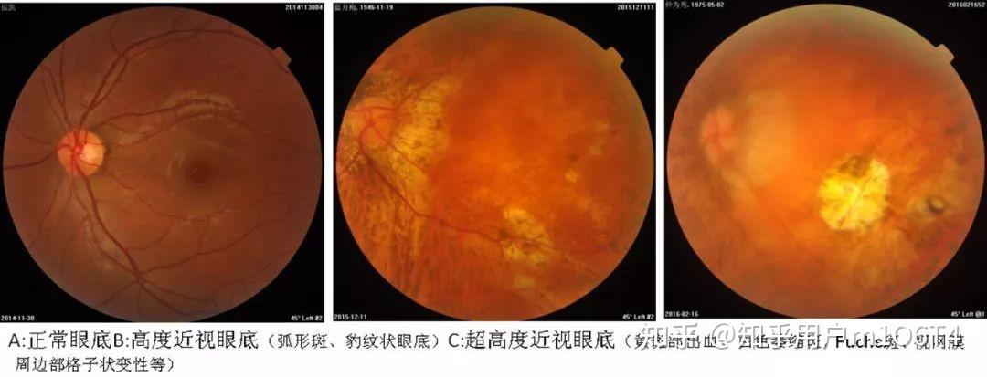 ①黄斑病变是近视的一大并发症,中国40岁以上人群近视黄斑病变10年