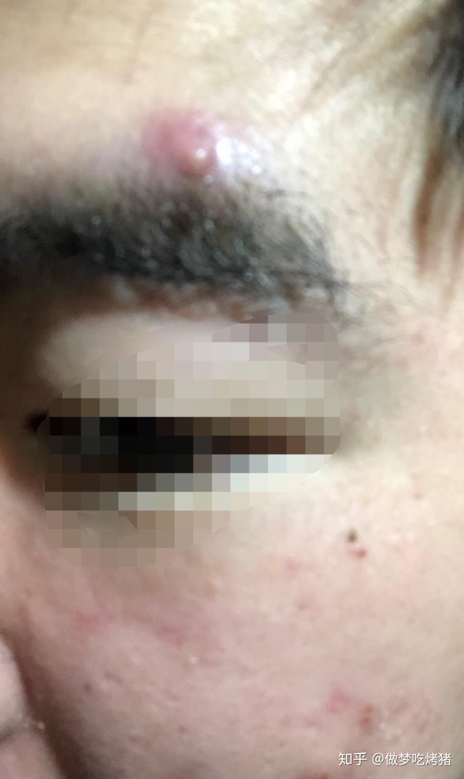 如何去除囊肿结节性痤疮的小方法